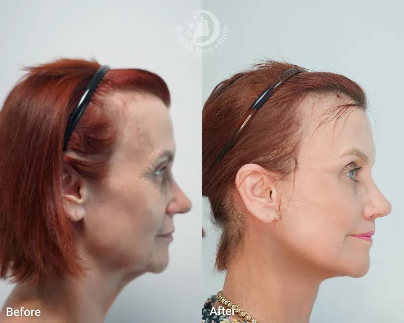 Facelift patient before and after, side profile