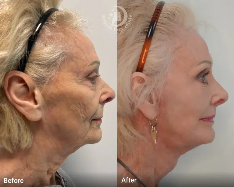 Second facelift patient before and after, side profile