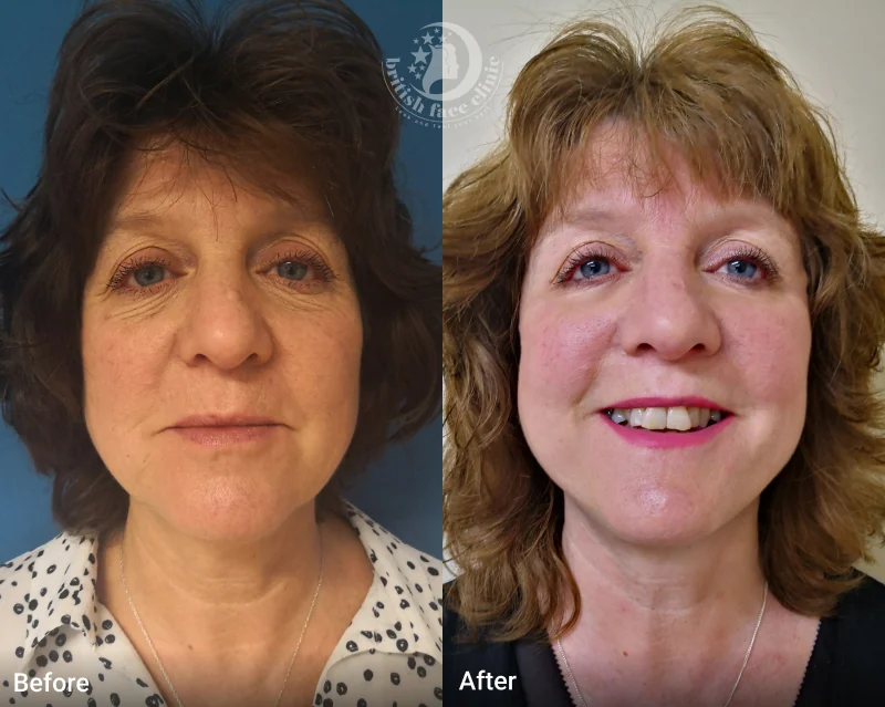 Mini facelift patient before and after