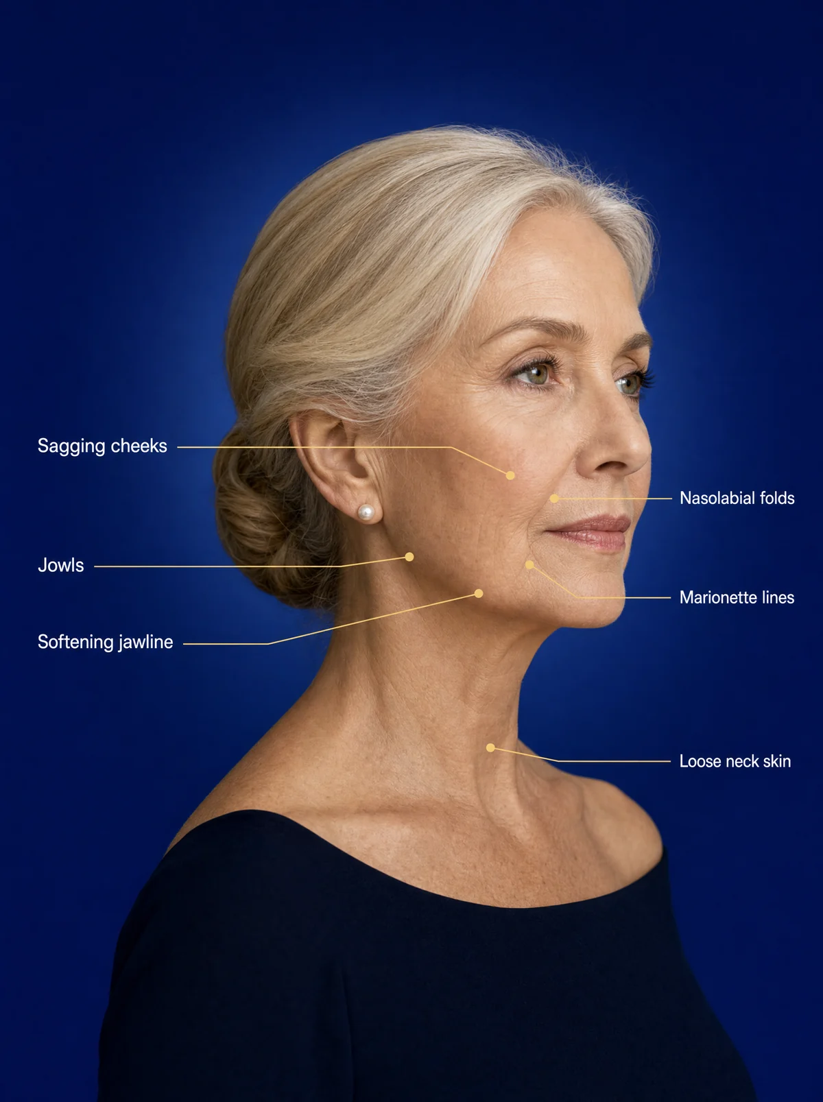 Woman in her fifties with labels pointing to sagging cheeks, nasolabial folds, marionette lines, jowls, a softening jawline and loose neck skin