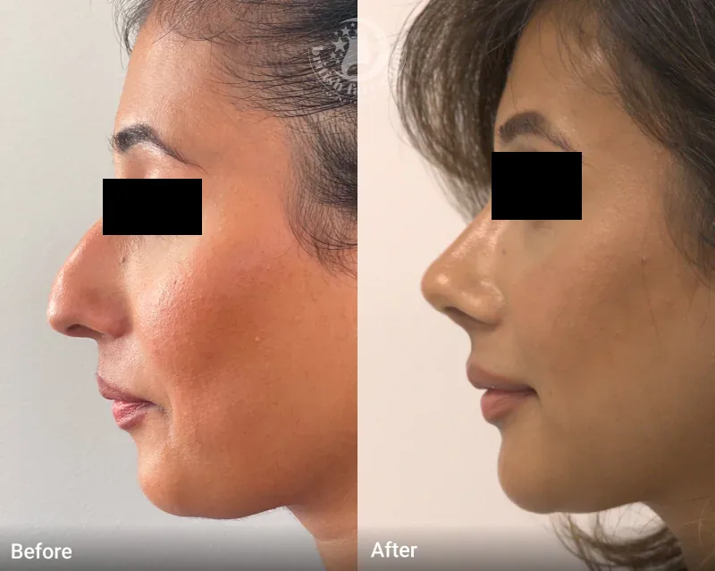 Rhinoplasty patient before and after