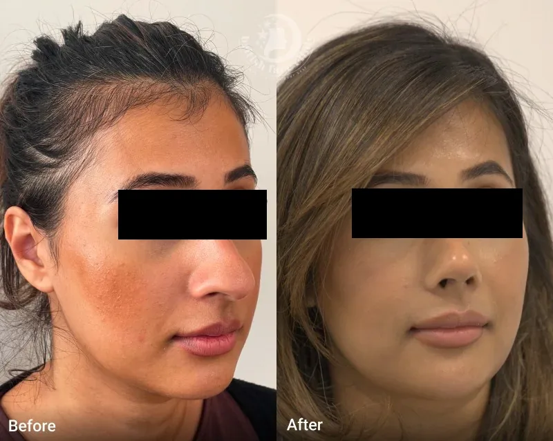 Rhinoplasty patient before and after, view 2 of 5