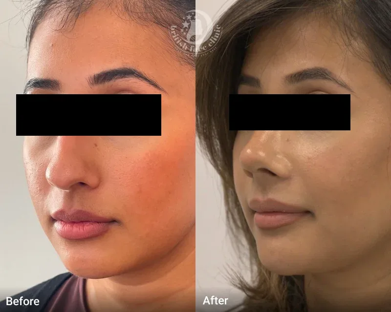 Rhinoplasty patient before and after, view 4 of 5