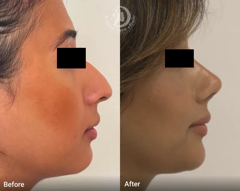 Rhinoplasty patient before and after, view 5 of 5